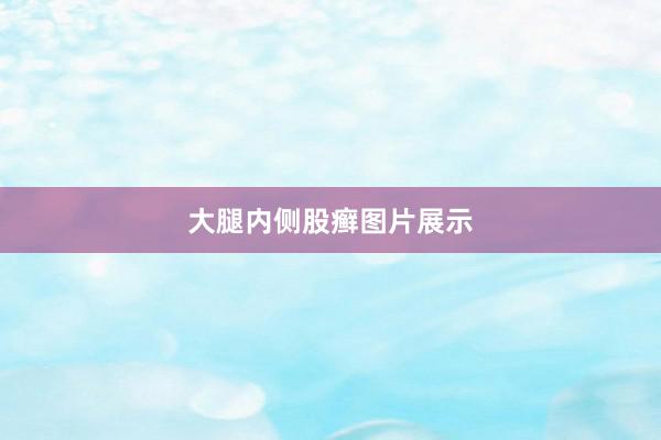 大腿内侧股癣图片展示